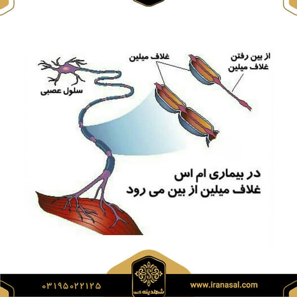 درمان ام اس