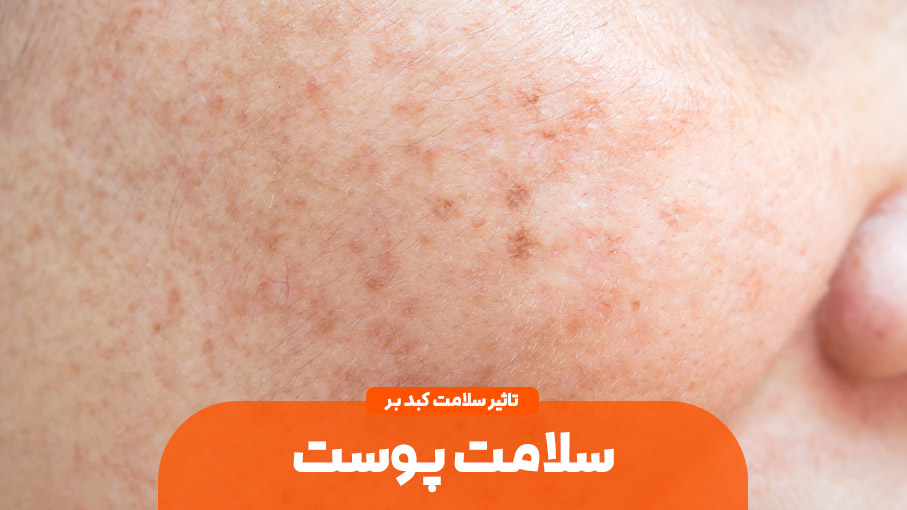 اثر عملکرد کبد بر روی پوست