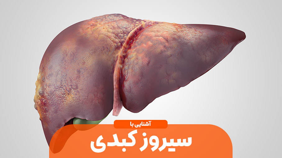 بیماری سیروز کبدی