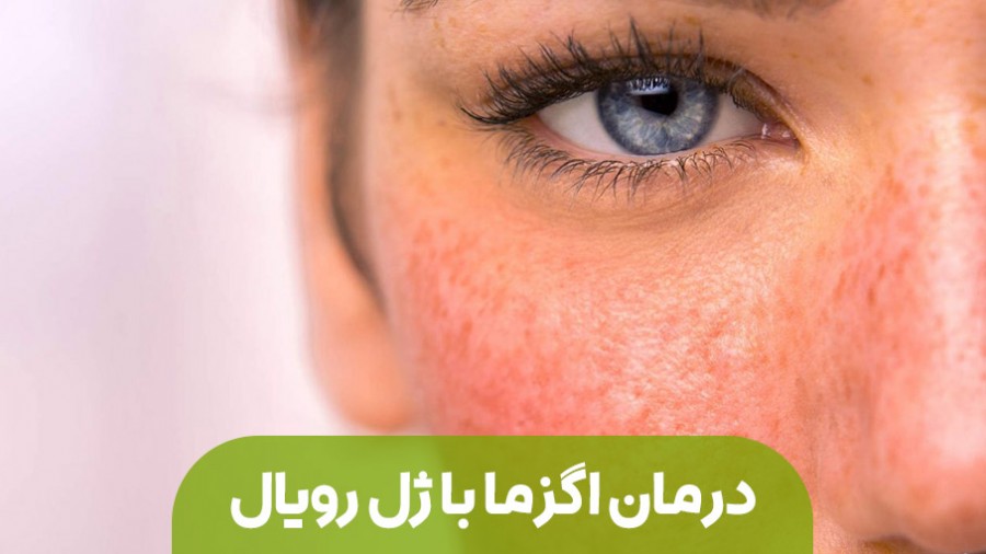 راه حلی بی نظیر برای درمان اگزما پوستی با ژل رویال