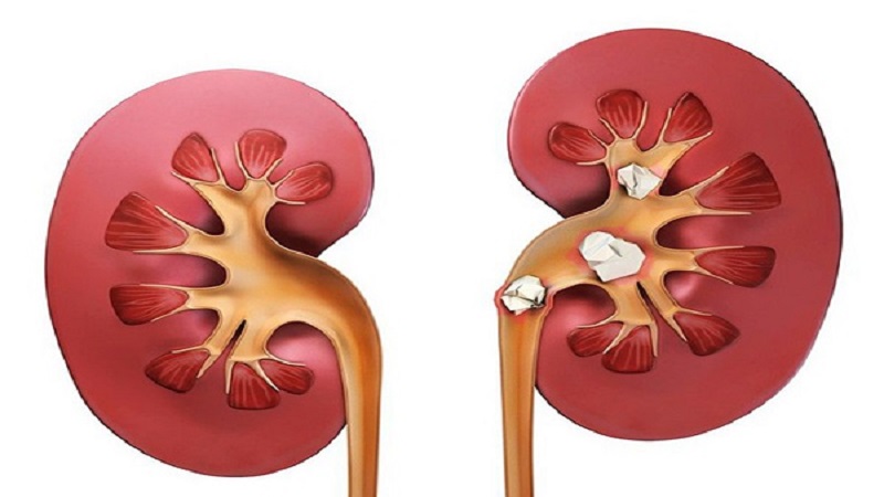 طب سنتی و درمان‌های خانگی برای تسکین درد و دفع سنگ کلیه