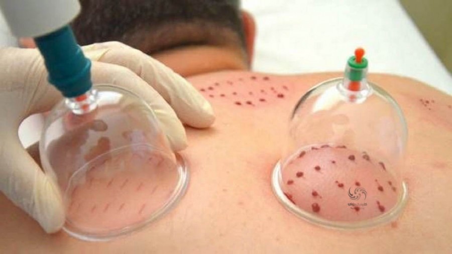 برای رفع ضعف و بی حالی بعد از حجامت حتما این نوشیدنی خوشمزه را امتحان کنید