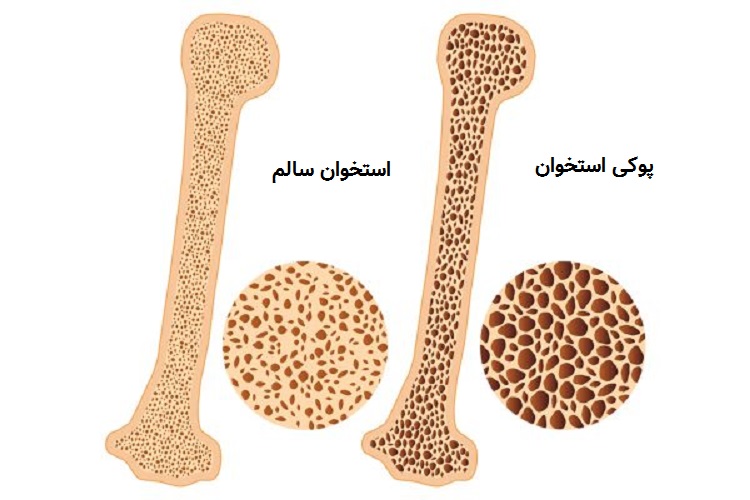 همه چیز در مورد ویتامین D و کلسیم / با چه خوراکی ها و راهکارهایی پوکی استخوان را نابود کنیم ؟