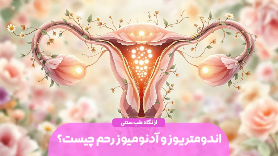 اندومتریوز و آدنومیوز از نگاه طب سنتی