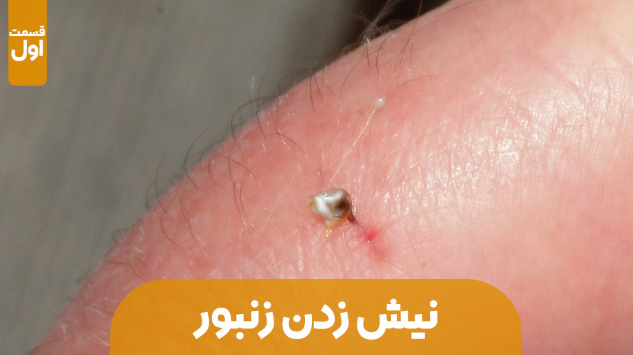 خطرات نیش زنبور عسل – قسمت اول