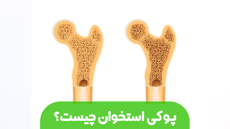 پوکی استخوان چیست و چرا به آن استئوپروز گفته می‌شود؟