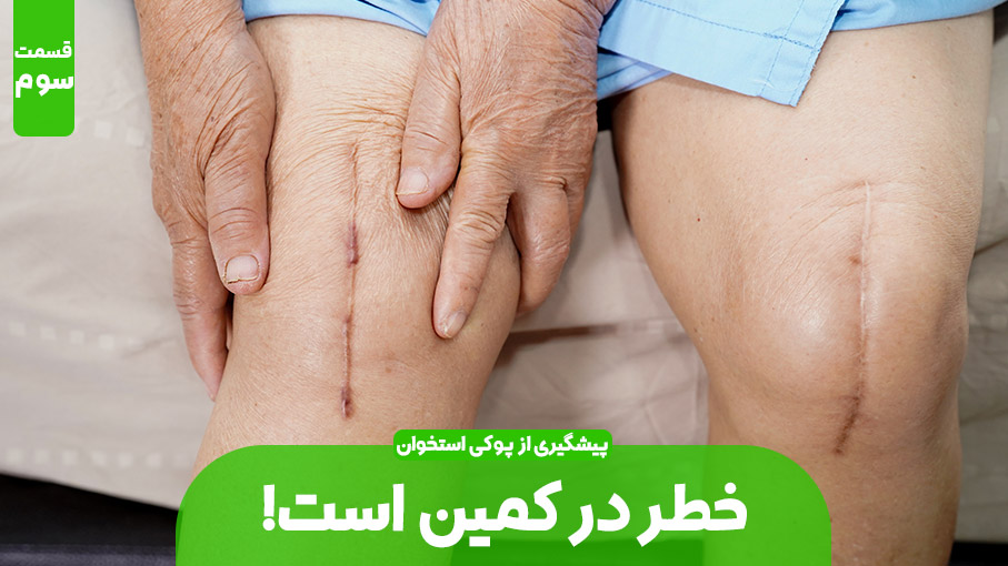 پیشگیری از مبتلا شدن به پوکی استخوان (بخش سوم)