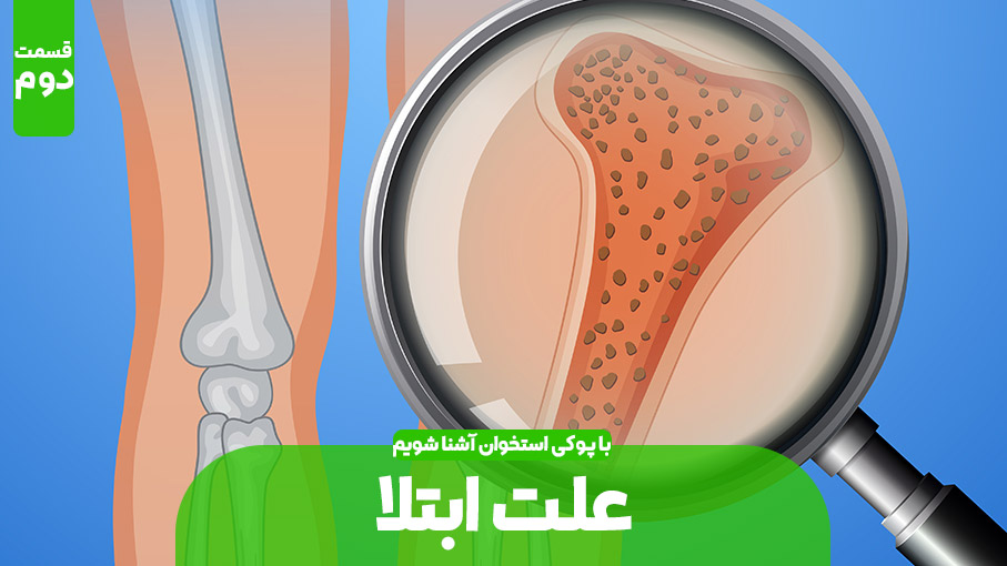 علت های پوکی استخوان (بخش دوم)