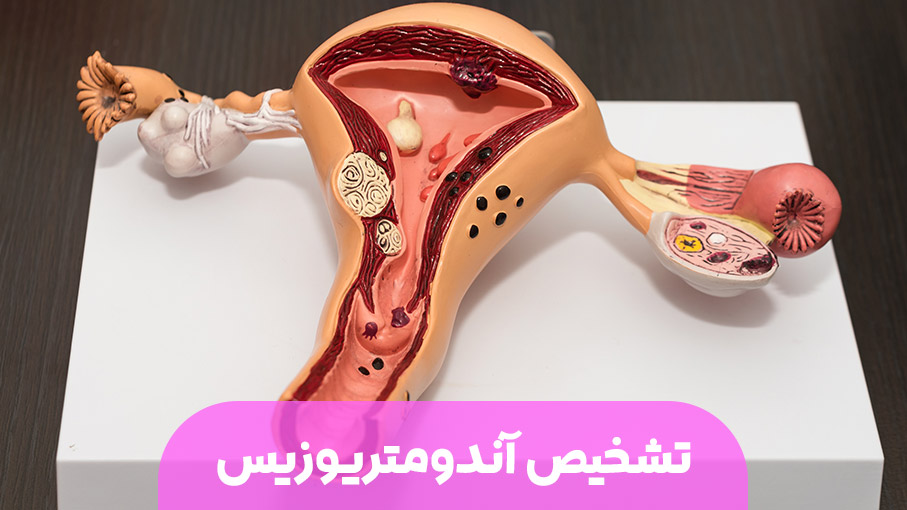 تشخیص و درمان آندومتریوزیس
