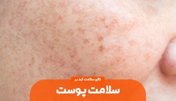 اثر عملکرد کبد بر روی پوست