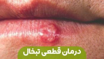 درمان قطعی تبخال با بره موم