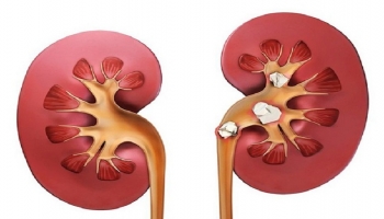 طب سنتی و درمان‌های خانگی برای تسکین درد و دفع سنگ کلیه