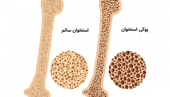 همه چیز در مورد ویتامین D و کلسیم / با چه خوراکی ها و راهکارهایی پوکی استخوان را نابود کنیم ؟