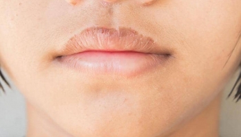 دلایل احتمالی ایجاد ترک و پوسته شدن لبها و درمان های طبیعی برای نرم شدن لبها