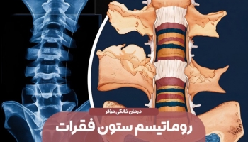 تمام علائم روماتیسم ستون فقرات + راه‌های تشخیص و درمان خانگی