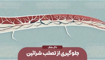 جلوگیری از تصلب شرائین