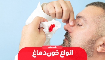 خون‌دماغ شدن از دیدگاه طب سنتی ایرانی
