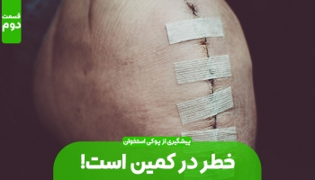 پیشگیری از مبتلا شدن پوکی استخوان (بخش دوم)