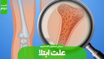 علت های پوکی استخوان (بخش دوم)